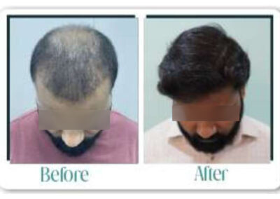Before & After