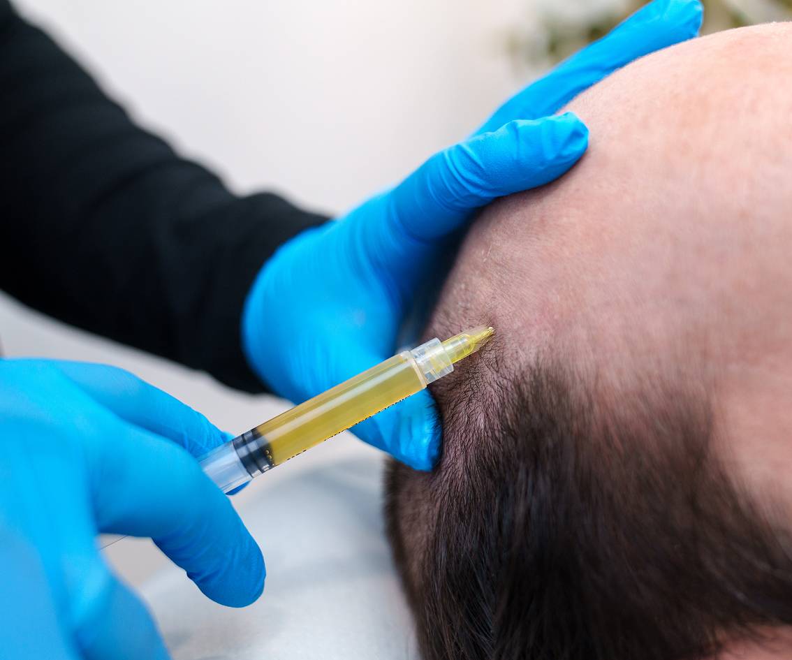 What to Expect During the Procedure-prp-mbl-img What to Expect During the Procedure-prp-mbl-img