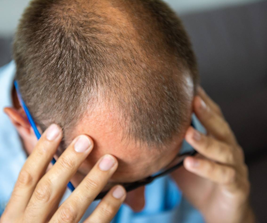 Who is Hair Transplant Treatment Ideal For-mbl-img Who is Hair Transplant Treatment Ideal For-mbl-img