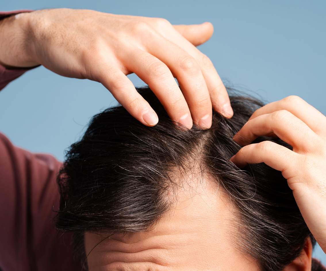 Who is Ideal for Hair Growth Treatment-mbl-img Who is Ideal for Hair Growth Treatment-mbl-img