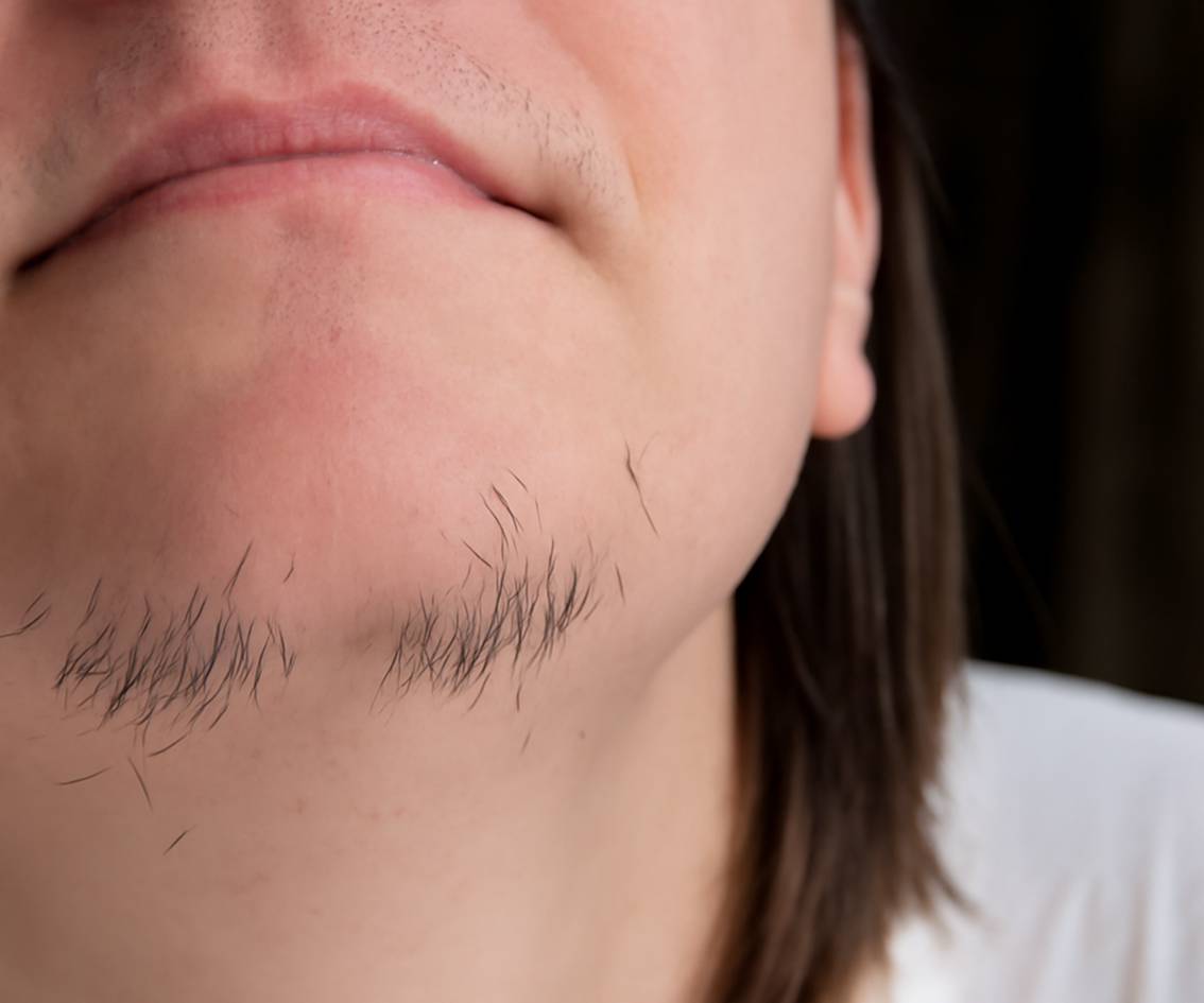 Who is Laser Hair Reduction Ideal For-mbl-img Who is Laser Hair Reduction Ideal For-mbl-img