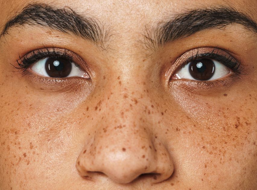 Areas Treated with Facial Pigmentation | Dr. Haror's Wellness