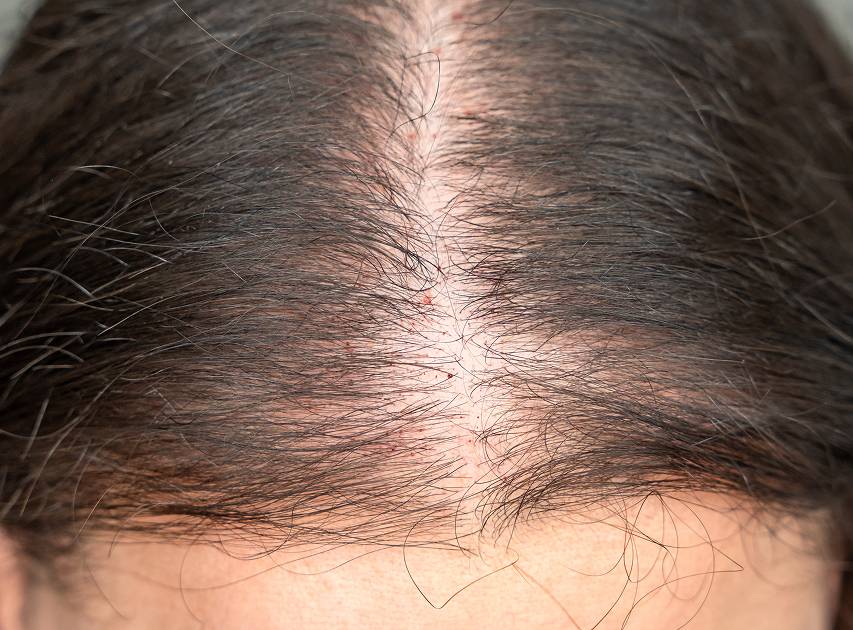 Areas Treated with Hair Growth | Dr. Haror's Wellness