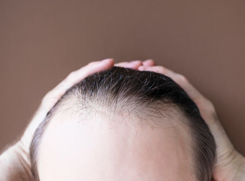 Areas Treated with Hair Transplant Treatment | Dr. Haror's Wellness