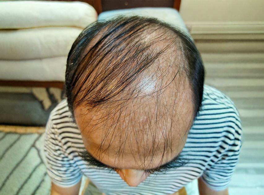 Areas Treated with PRP Hair Treatment | Dr. Haror's Wellness Areas Treated with PRP Hair Treatment | Dr. Haror's Wellness