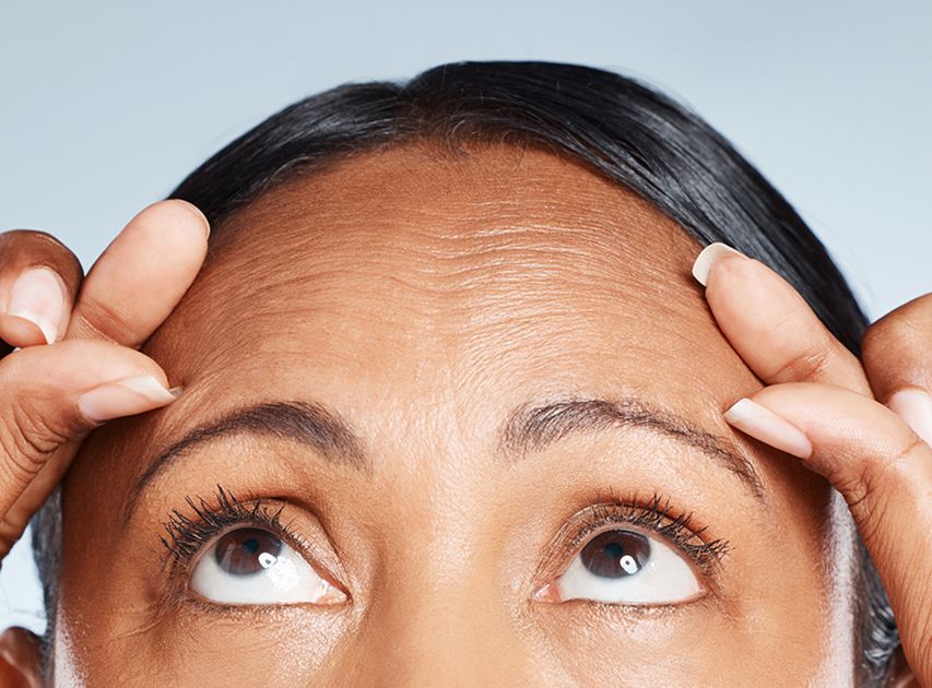 Candidates for Botox Treatment | Dr. Haror's Wellness