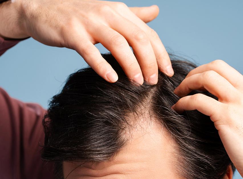 Candidates for Hair Growth | Dr. Haror's Wellness