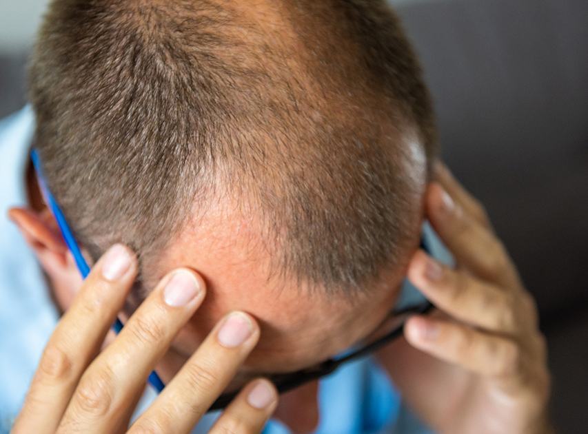 Candidates for Hair Transplant Treatment | Dr. Haror's Wellness Candidates for Hair Transplant Treatment | Dr. Haror's Wellness