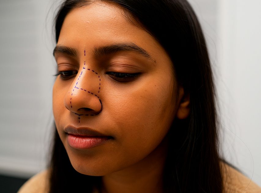Candidates for Non-Surgical Rhinoplasty | Dr. Haror's Wellness Candidates for Non-Surgical Rhinoplasty | Dr. Haror's Wellness