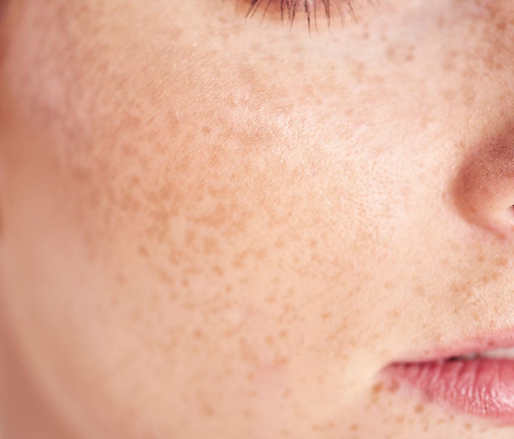 Common Myths About Facial Pigmentation | Dr. Haror's Wellness