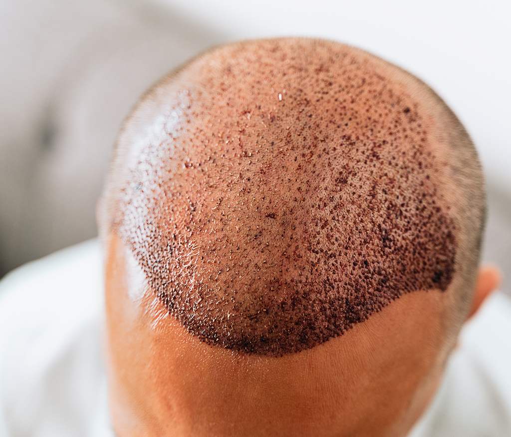 Common Myths About Hair Transplant Treatment | Dr. Haror's Wellness Common Myths About Hair Transplant Treatment | Dr. Haror's Wellness