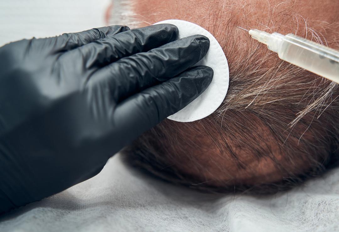 Hair Transplant Treatment | Dr. Haror's Wellness Hair Transplant Treatment | Dr. Haror's Wellness