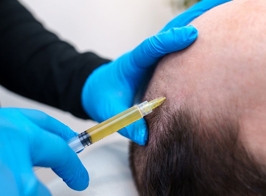 What to Expect During Prp | Dr. Haror's Wellness What to Expect During Prp | Dr. Haror's Wellness